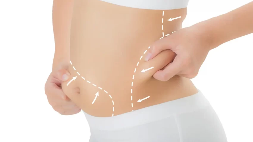 Liposuction Nedir?